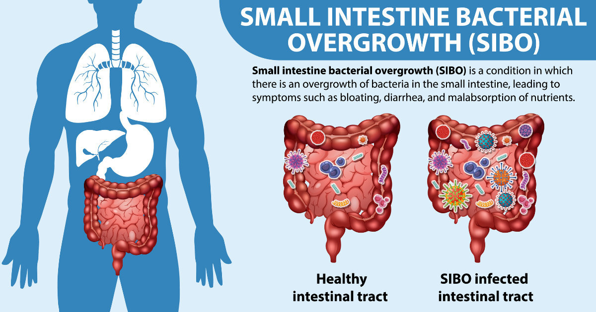 Sibo Diagram